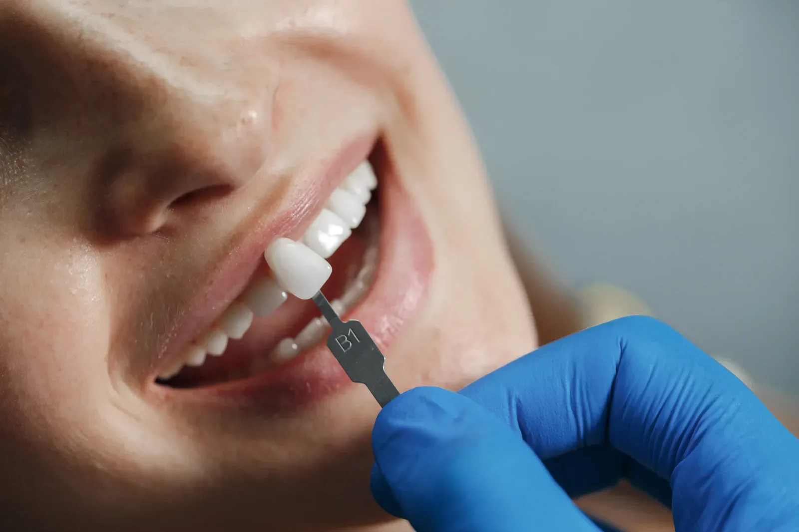 Gloved hand holding a tooth shade tab beside a person's smile